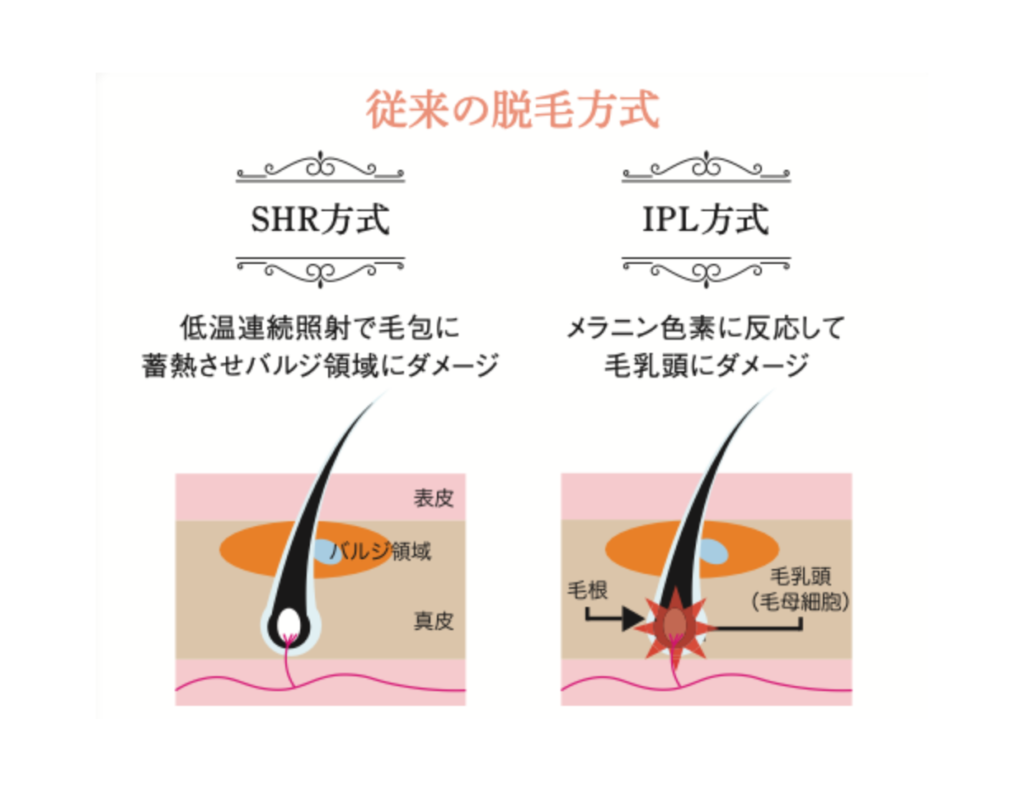 従来の脱毛の図